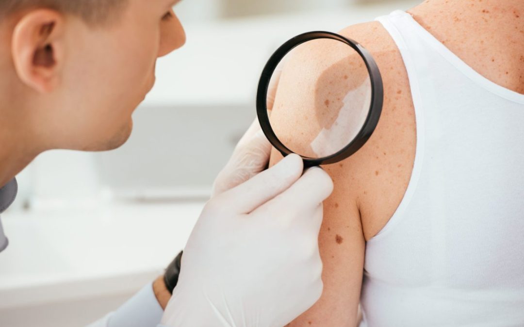 Understanding Skin Cancer