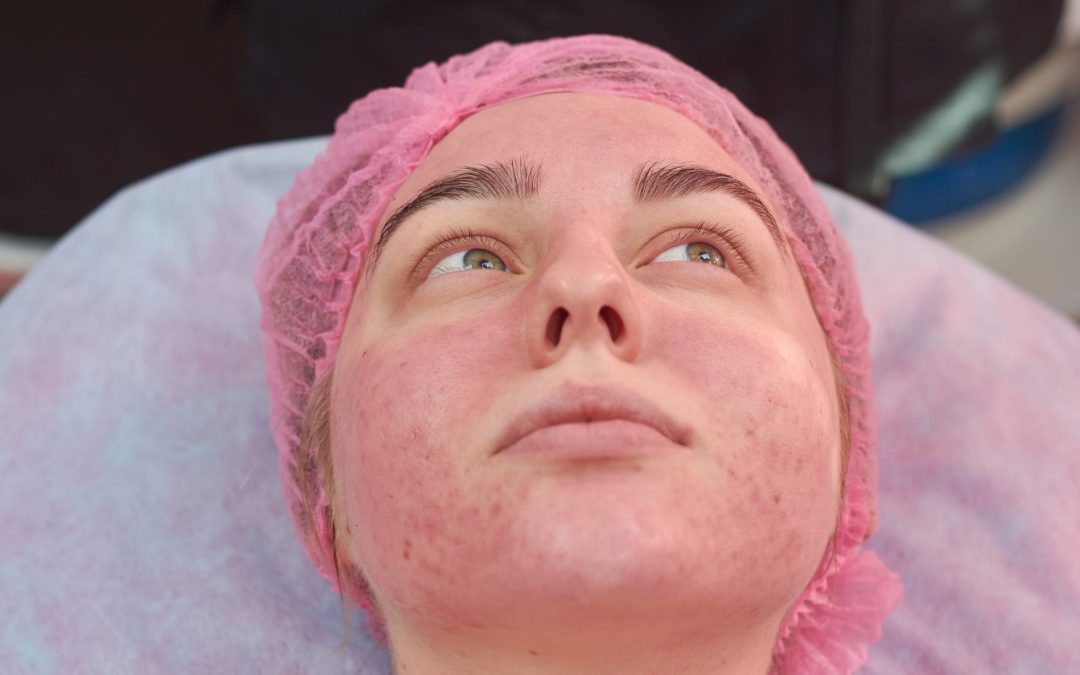 ROSACEA AWARENESS MONTH:  UNDERSTANDING ROSACEA & THE BENEFITS OF BBL TREATMENT