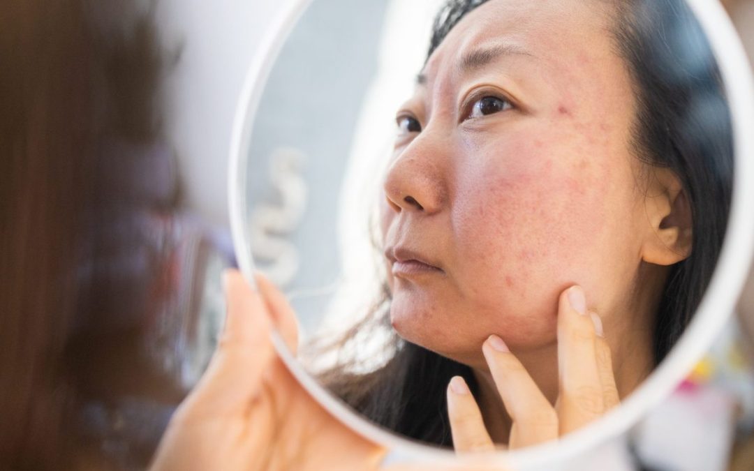Acne Scars
