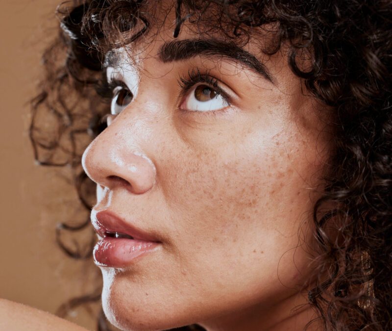 Hyperpigmentation 101