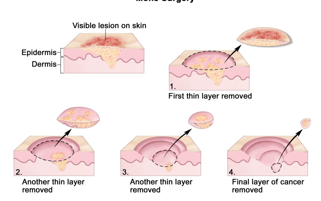 What is Mohs Surgery?