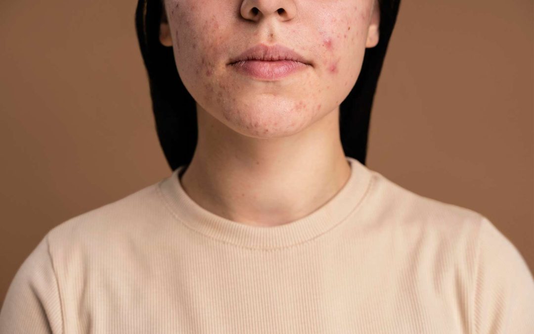 Why You Should See a Dermatologist for Acne
