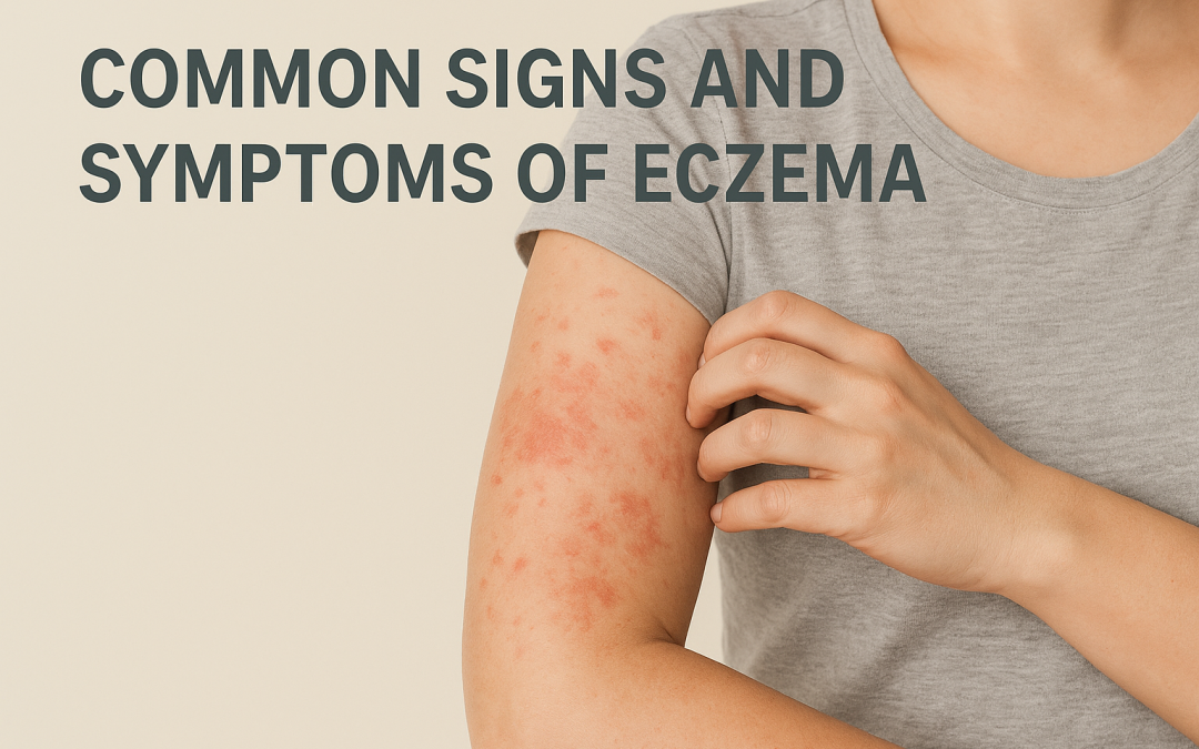 Common Signs and Symptoms of Eczema