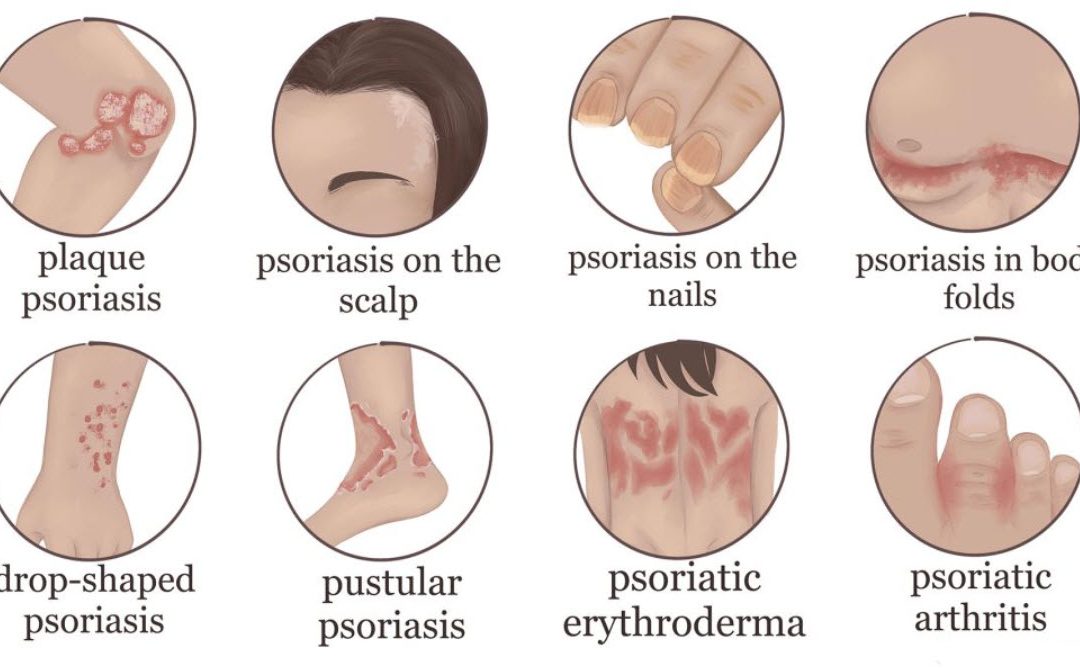 Common Signs of Psoriasis