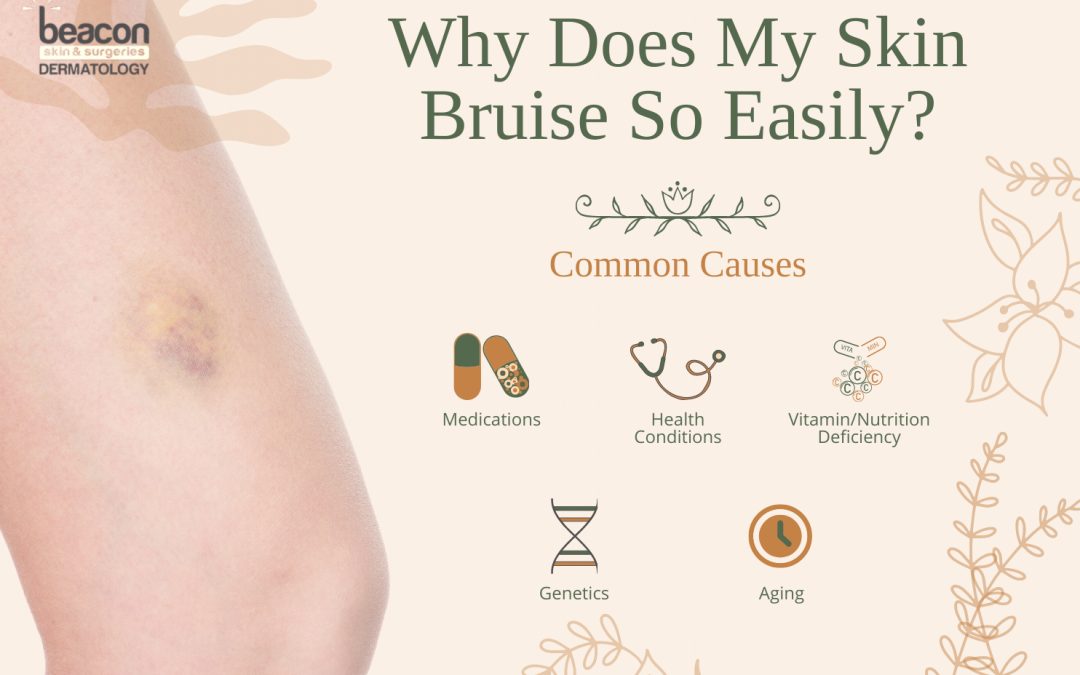 Why Does My Skin Bruise So Easily? Causes and Solutions