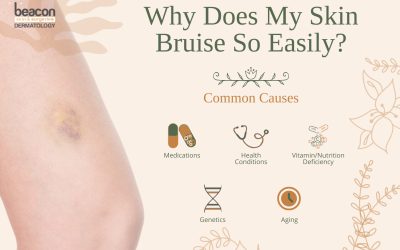 Why Does My Skin Bruise So Easily? Causes and Solutions