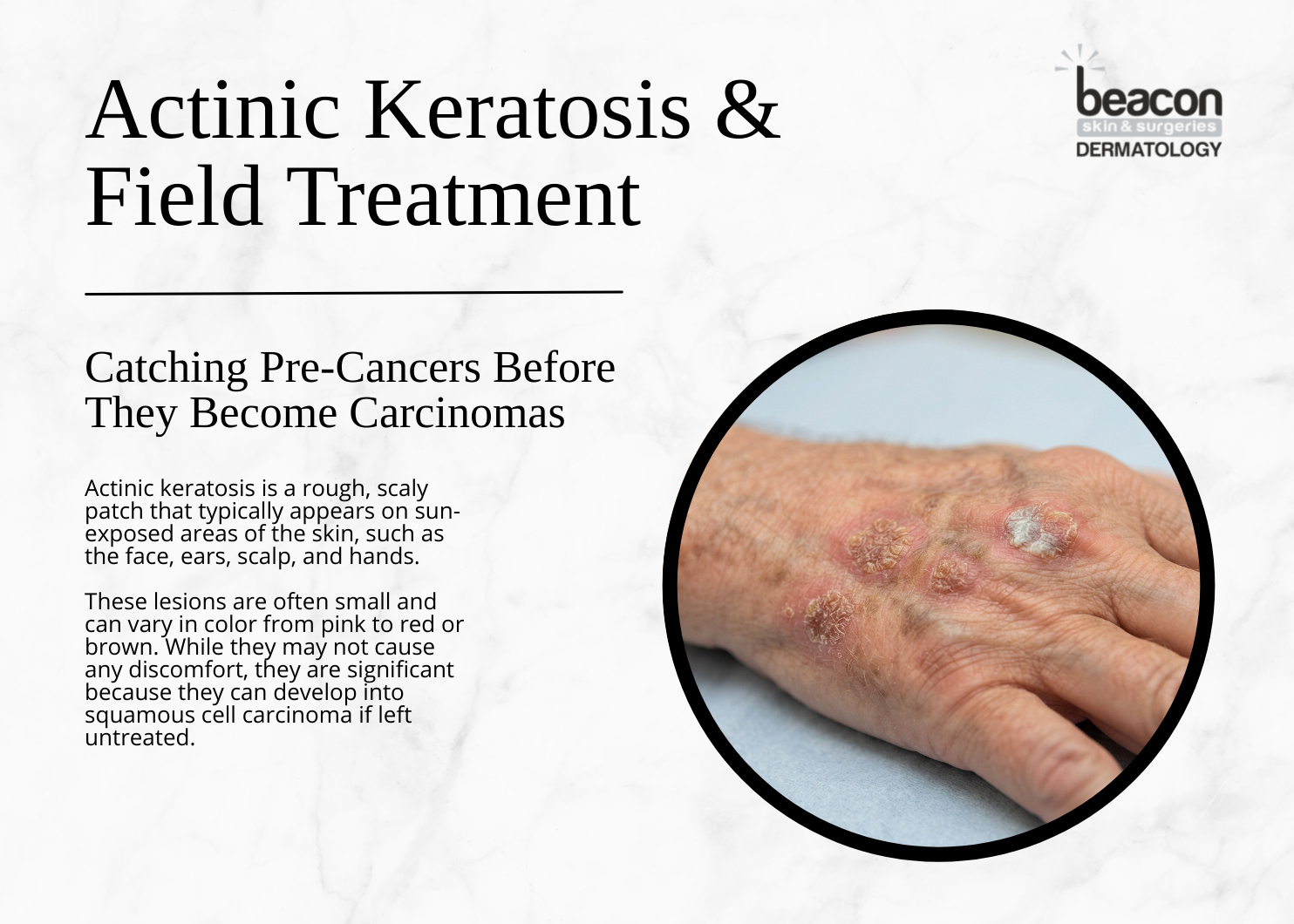 Actinic-Keratosis